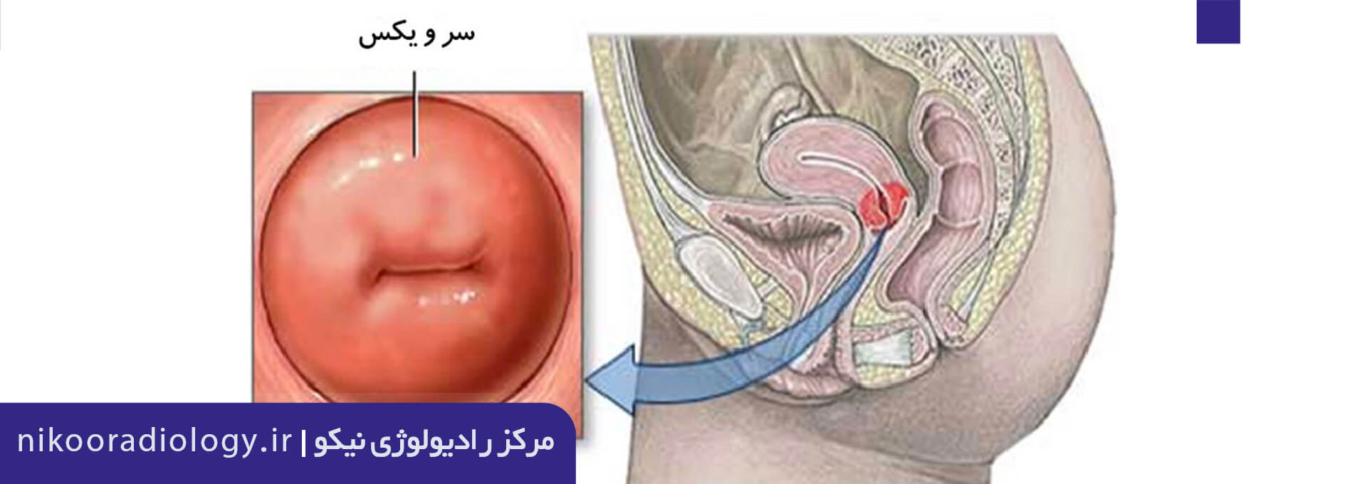 سونوگرافی طول سرویکس