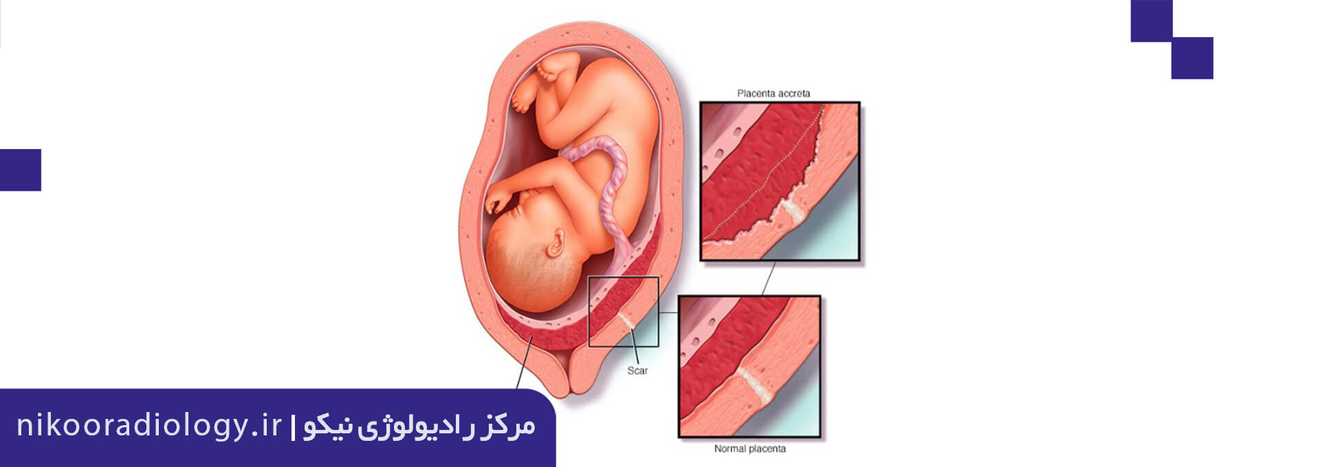 سونوگرافی محل جفت و چسبندگی محل جفت