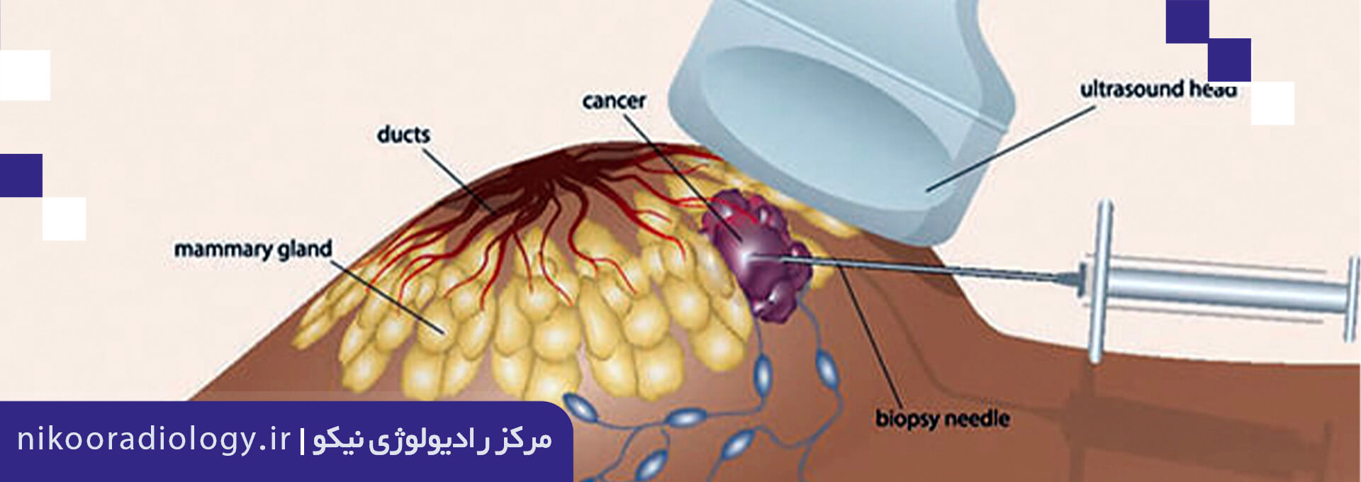 سونوگرافی پستان